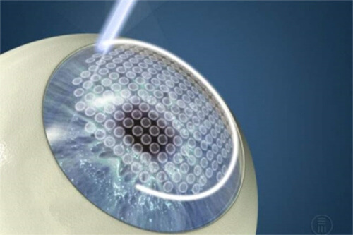 半飛秒激光手術過程 半飛秒激光手術過程