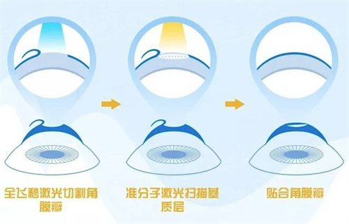 飛秒激光手術(shù)過程