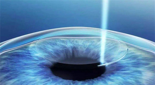 飛秒手術 飛秒手術