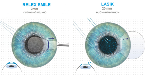全飛秒跟半飛秒對(duì)比