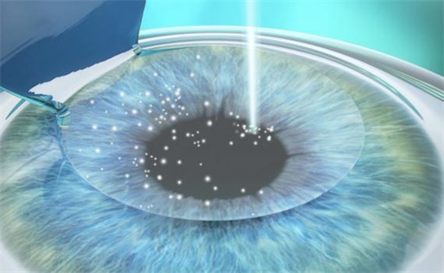 全飛秒手術(shù)原理