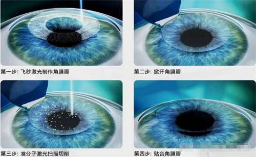飛秒激光手術(shù)示意圖