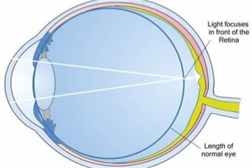 屈光不正近視示意圖 屈光不正近視示意圖