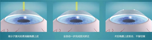 近視手術簡要流程 近視手術簡要流程