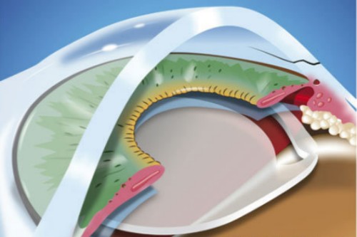 放入白內(nèi)障晶體