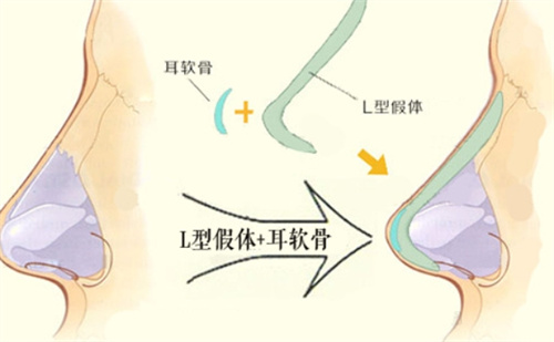 L形隆鼻假體 L形隆鼻假體