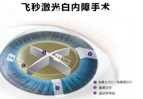 飛秒激光白內障手術 飛秒激光白內障手術
