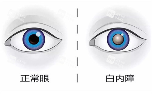 正常眼睛和白內(nèi)障