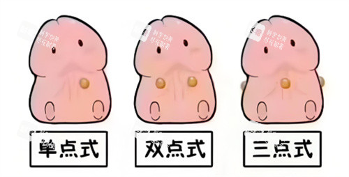 入珠手術(shù)動畫