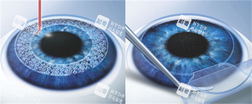 全飛秒手術(shù)圖示