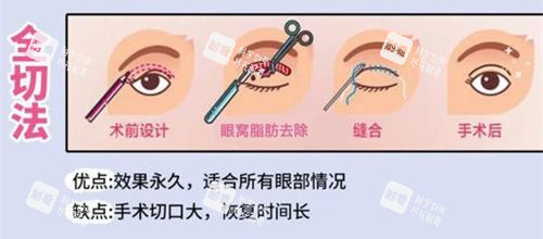 雙眼皮手術(shù)全切法動(dòng)畫(huà)演示圖