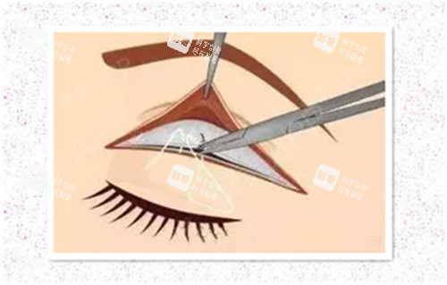 雙眼皮肉條修復(fù)術(shù)