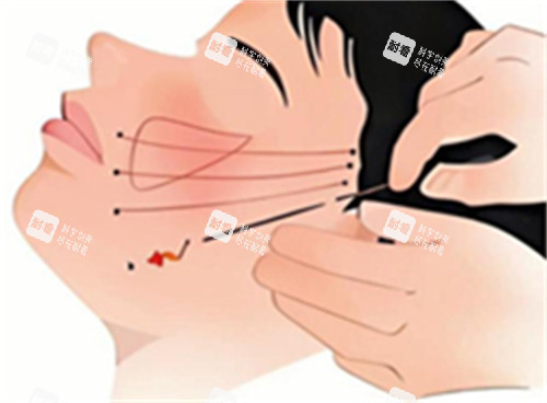 臉部拉皮卡通圖