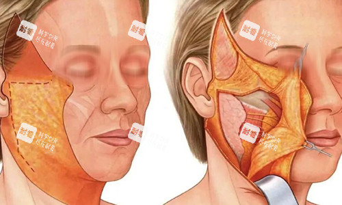 拉皮手術(shù)過程動畫示意圖