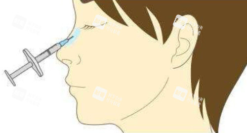 注射隆鼻側(cè)面