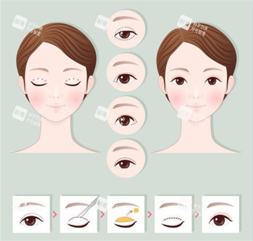 切開雙眼皮手術(shù)前后對比和過程