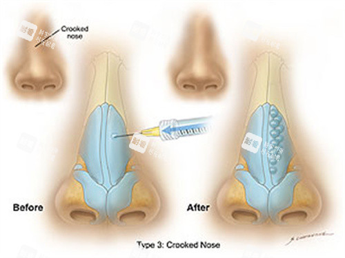 玻尿酸注射隆鼻前后對(duì)比