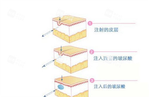 玻尿酸填充原理動(dòng)畫演示圖