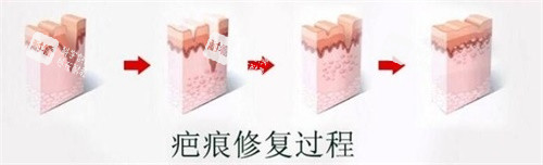 疤痕修復(fù)過程圖