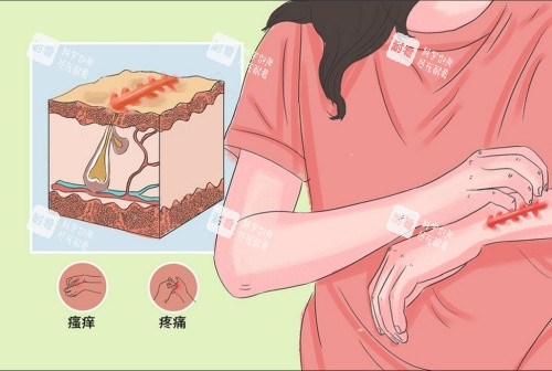 疤痕增生引起的癥狀示意圖