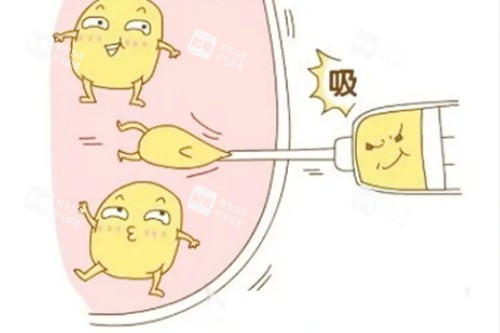 吸脂卡通展示圖