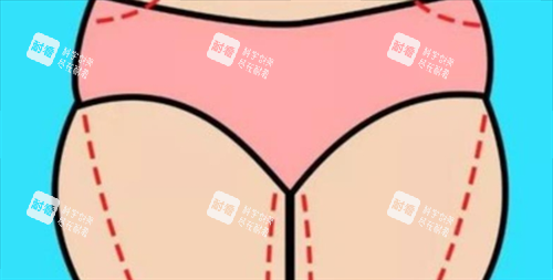 大腿吸脂術(shù)前畫線展示圖