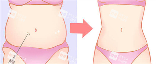 肚子吸脂前后對比 肚子吸脂前后對比