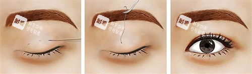 正在進(jìn)行的雙眼皮手術(shù)