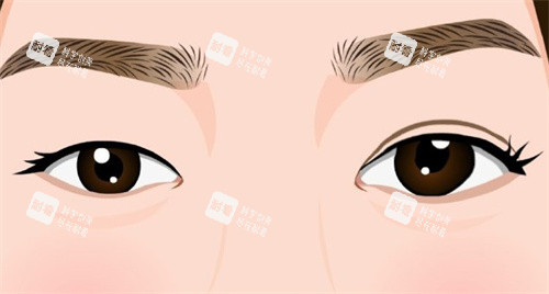 雙眼皮手術(shù)術(shù)前術(shù)后對比卡通