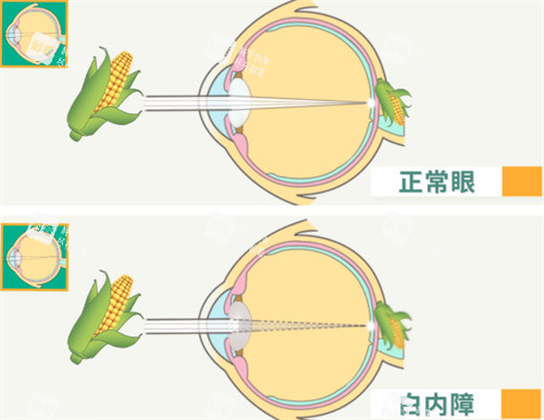 屈光性白內(nèi)障
