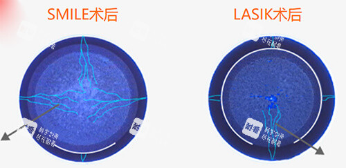 全飛秒和準分子激光手術術后漫畫圖