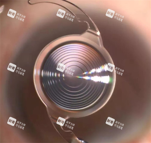 白內障竟晶體示意圖