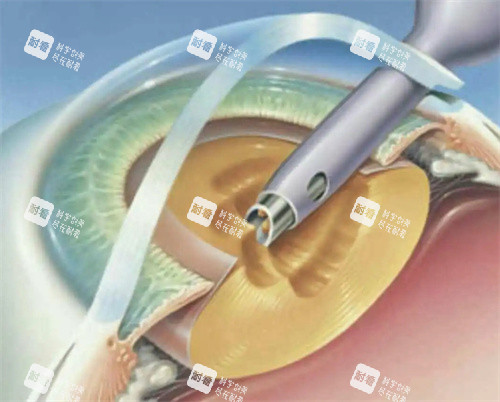 白內(nèi)障超聲乳化手術(shù)圖片