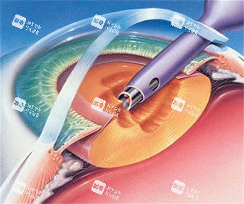白內(nèi)障囊外摘除術(shù)圖片 白內(nèi)障囊外摘除術(shù)圖片