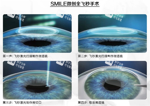 全飛秒手術(shù)過程