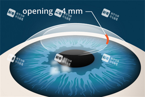 全飛秒手術(shù)動畫 全飛秒手術(shù)動畫