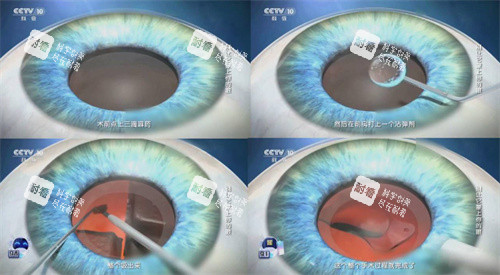 白內(nèi)障手術(shù)流程簡(jiǎn)圖 白內(nèi)障手術(shù)流程簡(jiǎn)圖