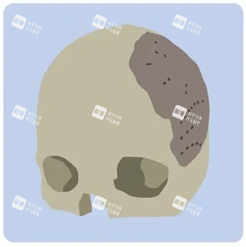 顱骨修復(fù)的對比動(dòng)畫圖