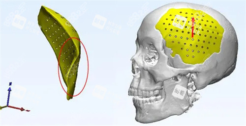 顱骨修復(fù)動(dòng)畫圖