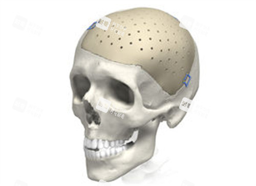 peek修復(fù)顱骨