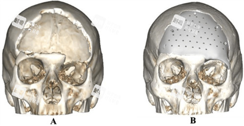 顱骨修補(bǔ)前后對比