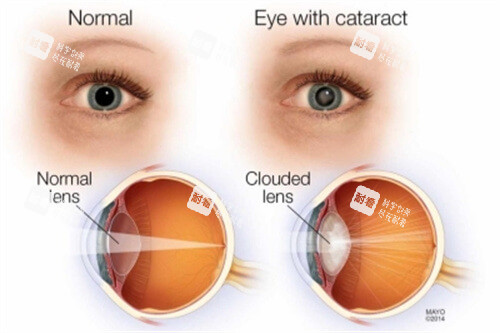 正常眼結(jié)構(gòu)與白內(nèi)障眼結(jié)構(gòu)對比