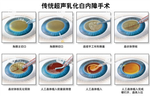 白內(nèi)障超聲乳化手術(shù)流程圖 白內(nèi)障超聲乳化手術(shù)流程圖
