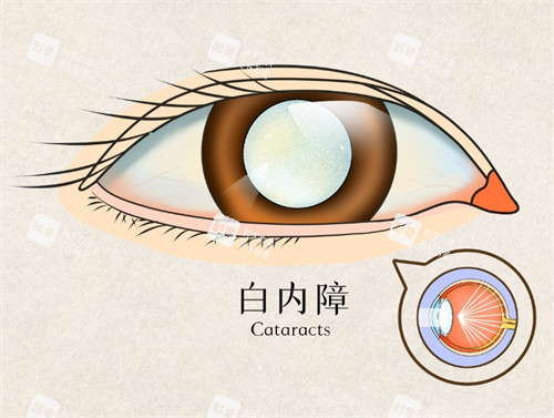 白內(nèi)障手術(shù)圖片 白內(nèi)障手術(shù)圖片