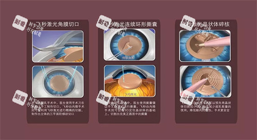 飛秒白內(nèi)障手術(shù)流程 飛秒白內(nèi)障手術(shù)流程