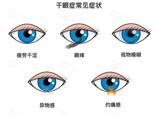 干眼癥常見癥狀