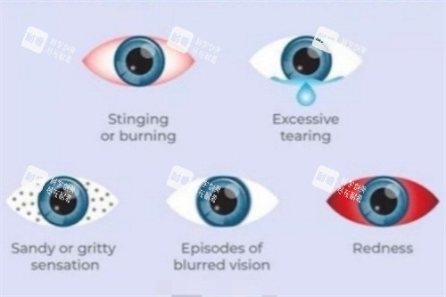 干眼癥五種常見癥狀