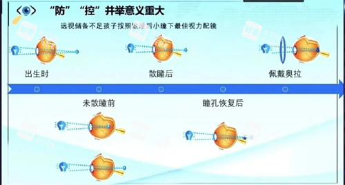 奧拉怒放離焦防控鏡片佩戴過程原理