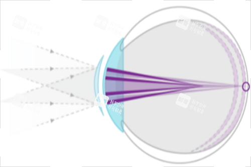 離焦鏡片光線示意圖