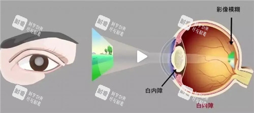 白內(nèi)障視力表現(xiàn)圖